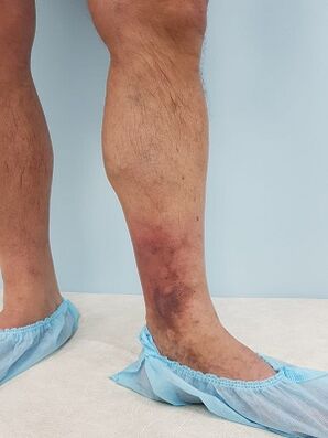 Complicaciones de las venas varicosas en los hombres.