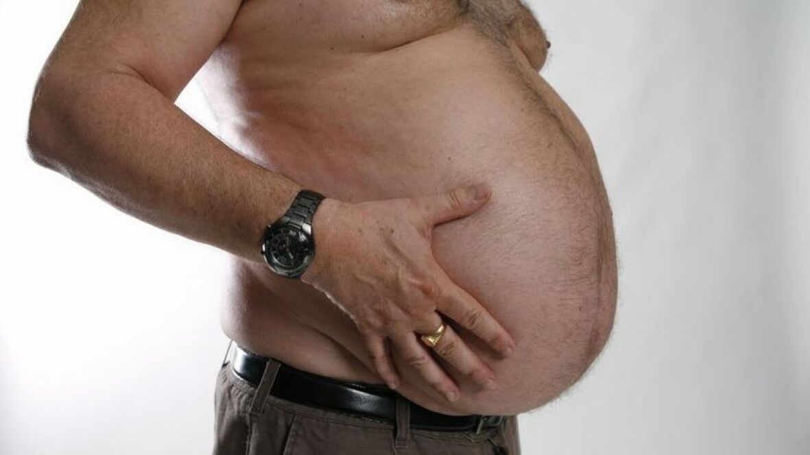 La obesidad como causa del desarrollo de varices