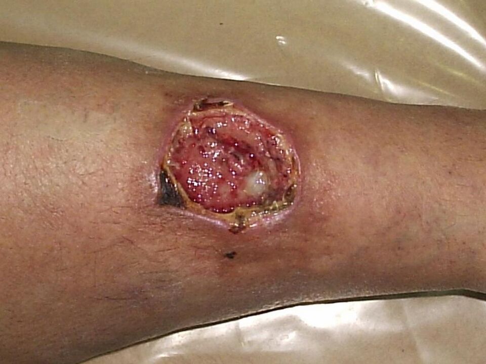 úlcera trófica con venas varicosas avanzadas
