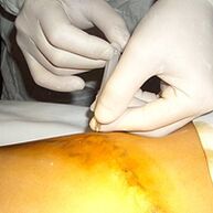 La miniflebectomía es el tratamiento más cosmético para las varices