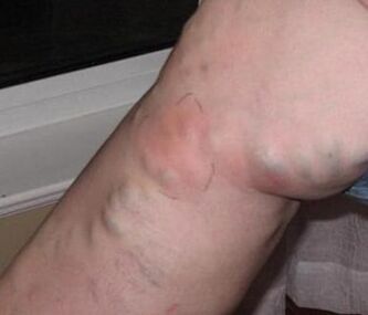 Tromboflebitis en la pierna con venas varicosas. 