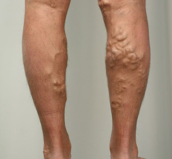 venas varicosas en las piernas