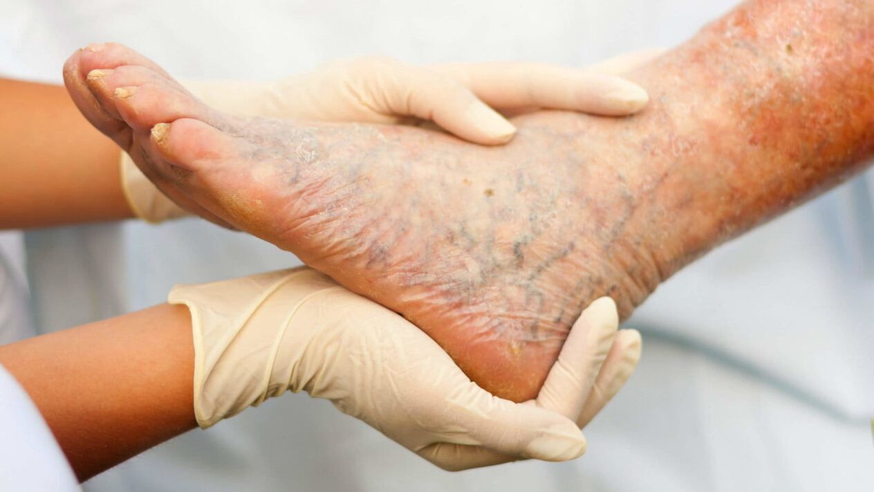 El flebólogo se ocupa del tratamiento de las venas varicosas en las piernas. 
