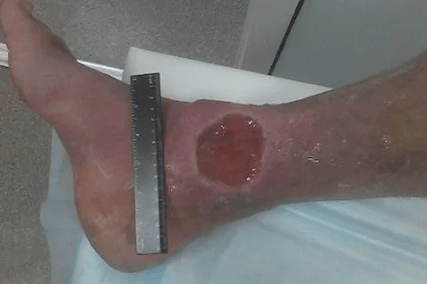 Complicaciones de las venas varicosas
